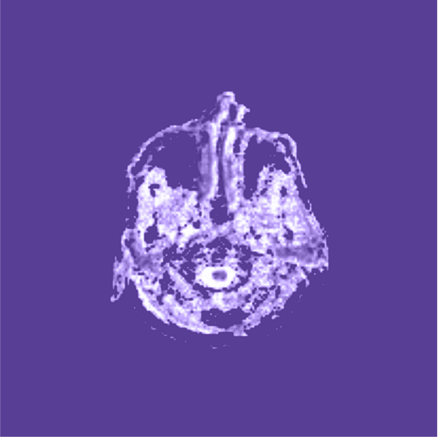 Cerebral Perfusion MRI Applications Of Perfusion MRI E MRI cerebral-perfusion-mri-applications-of-perfusion-mri-e-mri